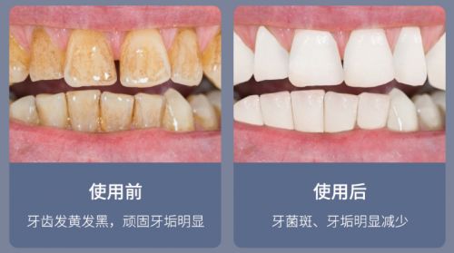 告別刷牙盲區，現代口腔護理新選擇 為何它能解決你的深層困擾